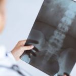 VA Misdiagnosis Results in Veteran Having Permanent Hole in His Spine